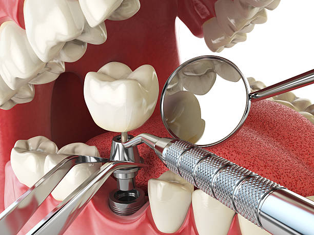 Best Emergency Root Canal Treatment in Westover, AL